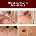Tags & Moles Remover